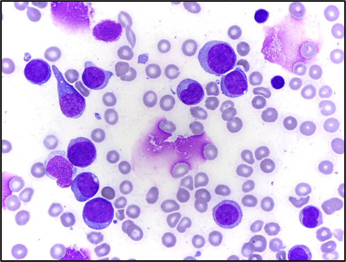 Some blasts show prominent cytoplasmic pseudopodial extensions.